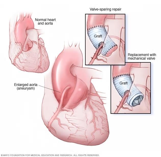 Behandling av aortasykdom med skalpell eller kateter? – Ikke enten-eller, men både-og