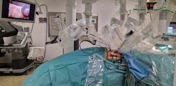 Bilde 1: Oppsett ved høyresidig robotassisterte adrenalektomi (RA). Sideleie med nyreknekk, høyre side opp. 12 mm trokar til leverhake samt hjelpe­port, tre robot-trokarer. Gjengitt med tillatelse fra pasienten.