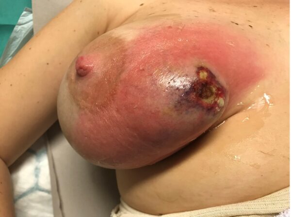 Figur 3: Bildet illustrerer mastitt hos ikke-operert pasient (ammende)- men illustrerer forløp dersom sen intervensjon.