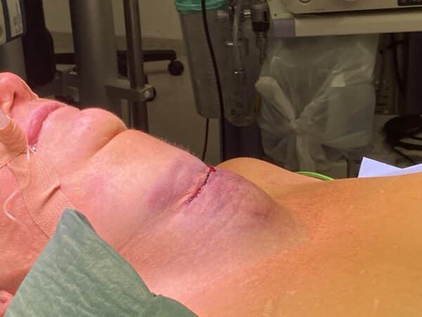 Figur 6: Bilde av postoperativt hematom. Legg merke til at pasienten er intubert uten evakuering av hematomet. Bildet brukes med godkjenning fra pasienten. 