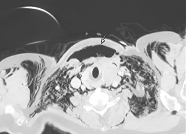 Figur 7: CT bilde av emfysem etter postoperativ trachealskade. Bildet brukes med godkjenning fra pasienten.