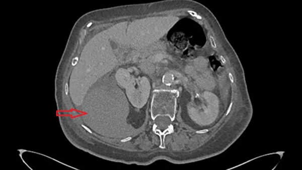 Figur 8: CT-bilde av spontant binyrehematom, hematom markert med rød pil.