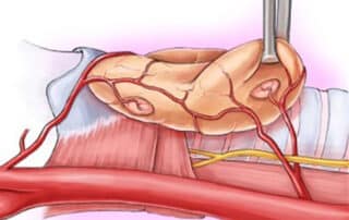 Figur 4: Her ser vi en mulig ­plassering av parathyreoidea­kjertlene i forhold til thyreoidea.