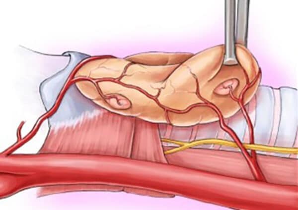 Figur 4: Her ser vi en mulig ­plassering av parathyreoidea­kjertlene i forhold til thyreoidea.