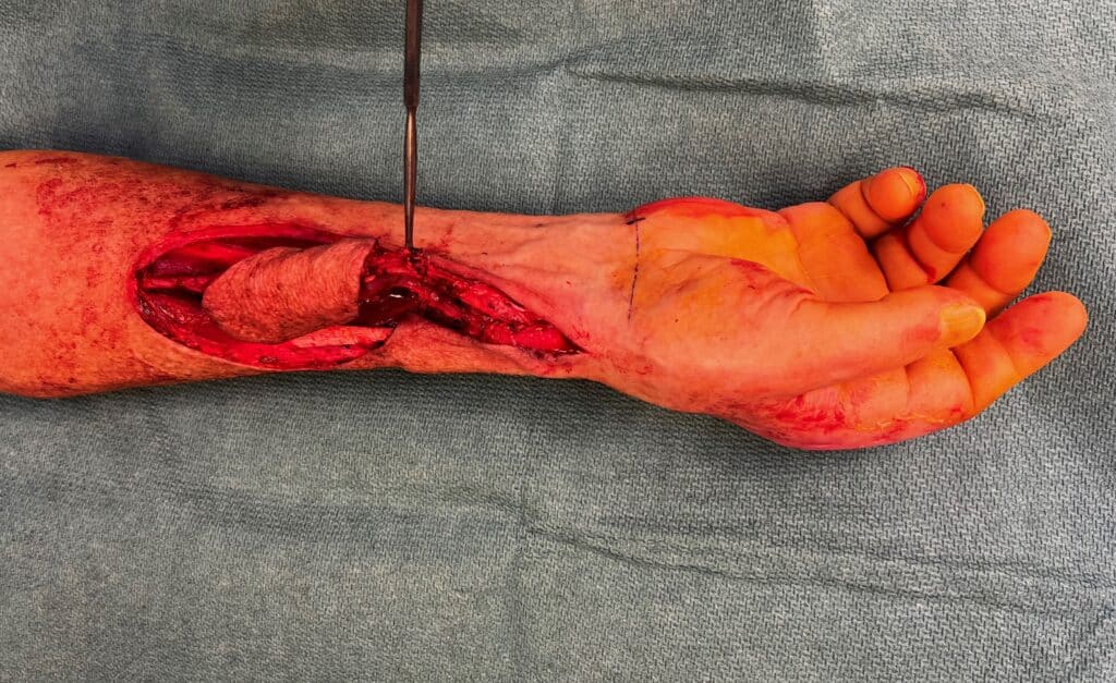 Bilde 3: Peroperativ. Revers radialis-lapp. Lappen sirkuleres retrograd/­reverst via anastomoser med arteria ulnaris.