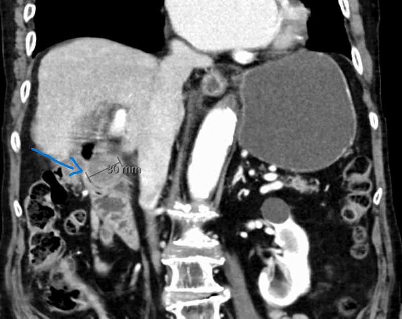 Figur 1: CT abdomen, koronalt snitt. Gallestein (30 mm) i pars descendens duodeni som forårsaker mekanisk obstruksjon (pil).