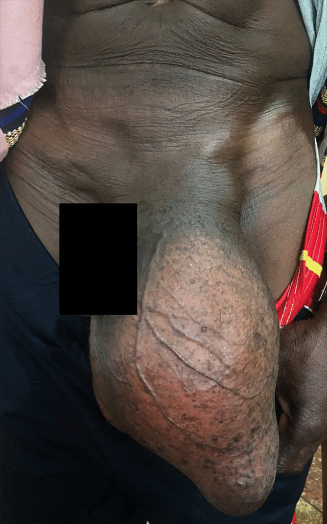 Figur 2. Et massivt venstresidig skrotalbrokk. Generell kirurger i Ghana blir i stor grad konfrontert med store, komplekse skrotale brokk. Opplæringen retter seg også mot trygg håndtering av disse. På bildet ser du et eksempel av et stort venstresidig skrotalbrokk som vi opererte under kurset. Pasienten har samtykket til deling.