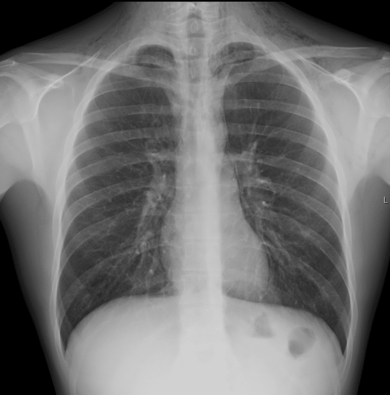 Bilde 1. Subkutant emfysem over collum og apikale deler av lungene bilateralt og mistanke om ­pneumomediastinum. Pasienten har samtykket til publisering av bildet.