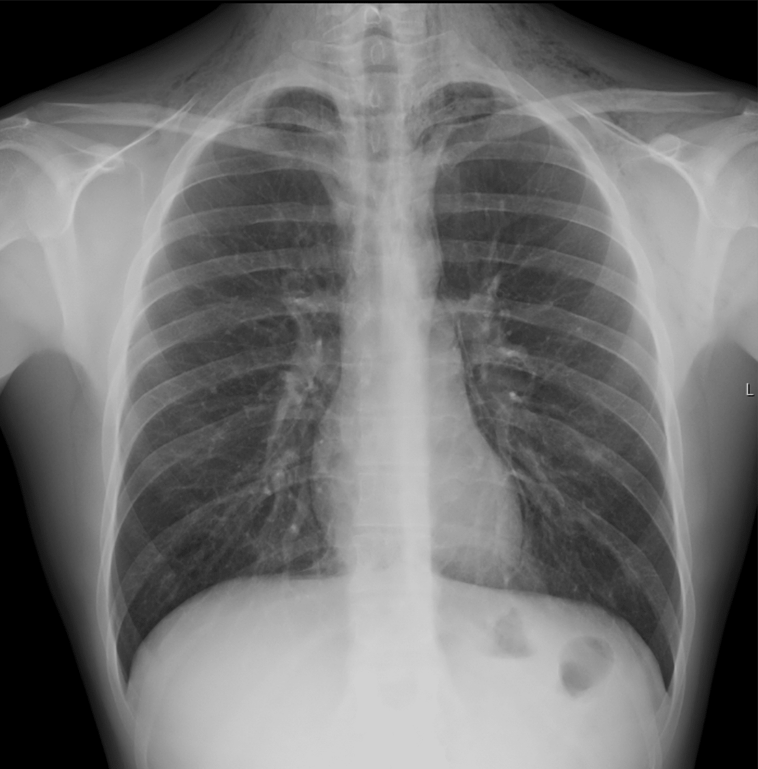 Bilde 1. Subkutant emfysem over collum og apikale deler av lungene bilateralt og mistanke om ­pneumomediastinum. Pasienten har samtykket til publisering av bildet.
