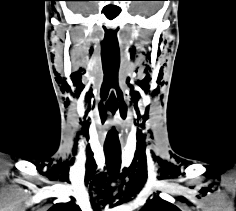 Bilde 2. Utbredt subkutant emfysem, pneumomediastinum og sublottisk rift. Dog kan sikker ­trakealdefekt ikke visualiseres. Pasienten har samtykket til publisering av bildet.
