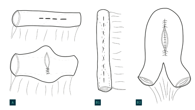 Figur 2. Strikturplastikker. A) Plastikk ved korte stenoser, Heinecke-Mikulicz. B1 og B2) Plastikk ved lengre stenoser, Finney. - Kirurgen Figur 2. Strikturplastikker. A) Plastikk ved korte stenoser, Heinecke-Mikulicz. B1 og B2) Plastikk ved lengre stenoser, Finney.