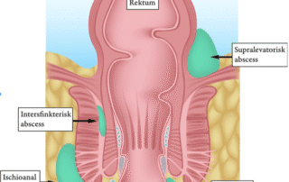 Figur 1: Anatomisk oversikt over lokalisasjoner for perianale abscesser. ­Illustrasjon: Ihor - Adobe Stock