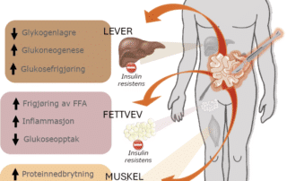 Figur 1: Kirurgi og inflammasjon fra syk tarm hos IBD-pasienter frigjør inflammasjonsmediatorer som gir en multi­organ-insulinresistens som er hovedkjennetegnet ved den katabole tilstanden til pasientene. Muskulatur reduserer ­forbrenningen av glukose og øker fettforbrenningen, mens proteiner brytes aktivt ned. Fettvev frigjør frie fettsyrer samt forsterker inflammasjonsresponsen. Leveren tømmer energilagrene og frigjør fritt ­glukose, hoved­sakelig i form av nedbrytning av glykogen og øker egenproduksjonen av glukose gjennom ­glukoneogenese. (­Figur laget av Martin Hagve)