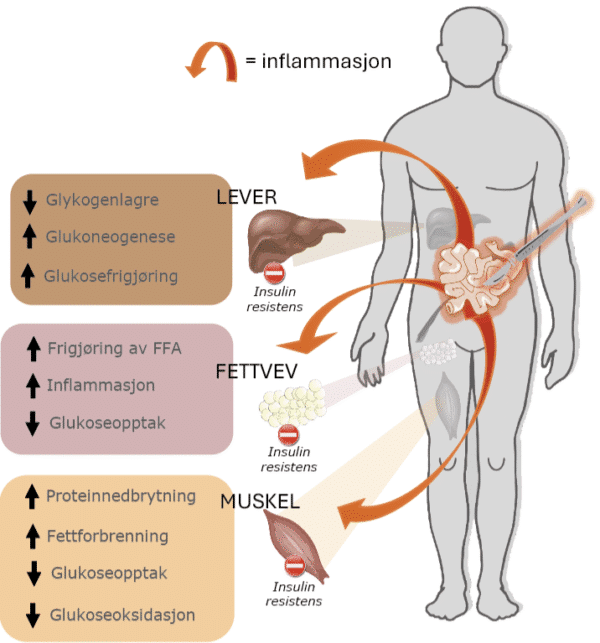 Figur 1: Kirurgi og inflammasjon fra syk tarm hos IBD-pasienter frigjør inflammasjonsmediatorer som gir en multiorgan-insulinresistens som er hovedkjennetegnet ved den katabole tilstanden til pasientene. Muskulatur reduserer forbrenningen av glukose og øker fettforbrenningen, mens proteiner brytes aktivt ned. Fettvev frigjør frie fettsyrer samt forsterker inflammasjonsresponsen. Leveren tømmer energilagrene og frigjør fritt glukose, hovedsakelig i form av nedbrytning av glykogen og øker egenproduksjonen av glukose gjennom glukoneogenese. (Figur laget av Martin Hagve) - Kirurgen Figur 1: Kirurgi og inflammasjon fra syk tarm hos IBD-pasienter frigjør inflammasjonsmediatorer som gir en multiorgan-insulinresistens som er hovedkjennetegnet ved den katabole tilstanden til pasientene. Muskulatur reduserer forbrenningen av glukose og øker fettforbrenningen, mens proteiner brytes aktivt ned. Fettvev frigjør frie fettsyrer samt forsterker inflammasjonsresponsen. Leveren tømmer energilagrene og frigjør fritt glukose, hovedsakelig i form av nedbrytning av glykogen og øker egenproduksjonen av glukose gjennom glukoneogenese. (Figur laget av Martin Hagve)