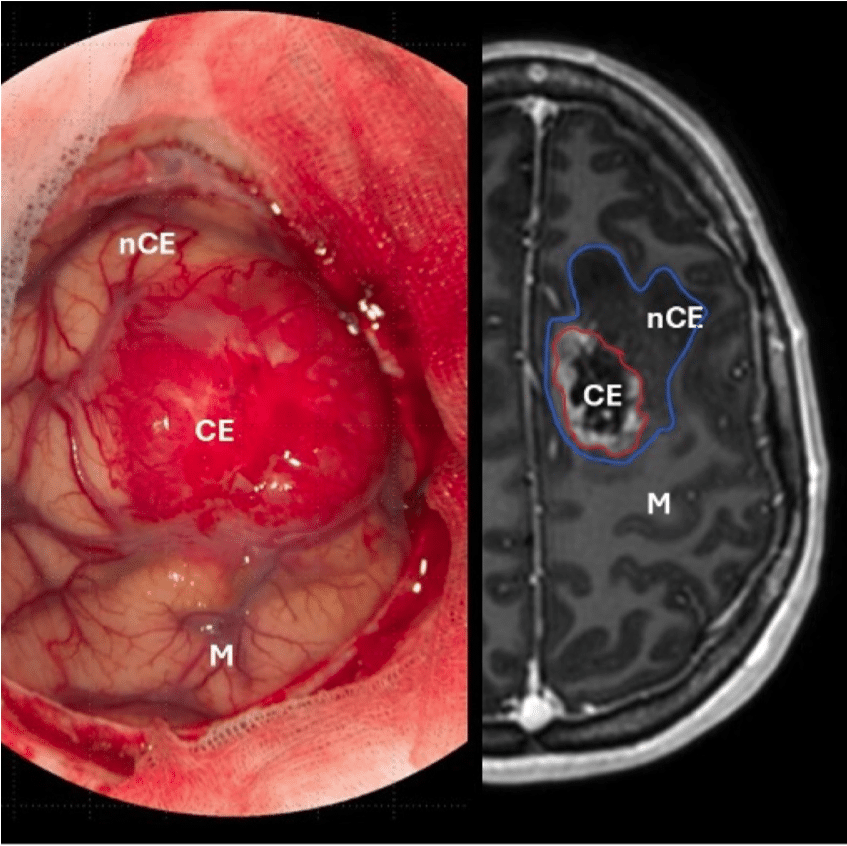 Kirurgisk behandling  av høygradige gliomer