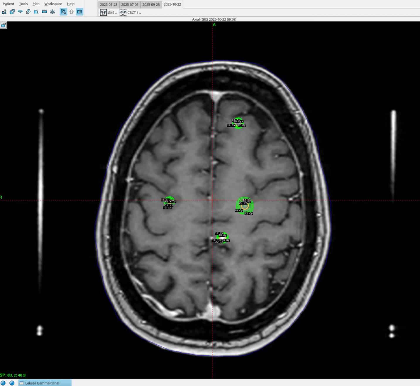 Stråleknivbehandling av hjernesvulst